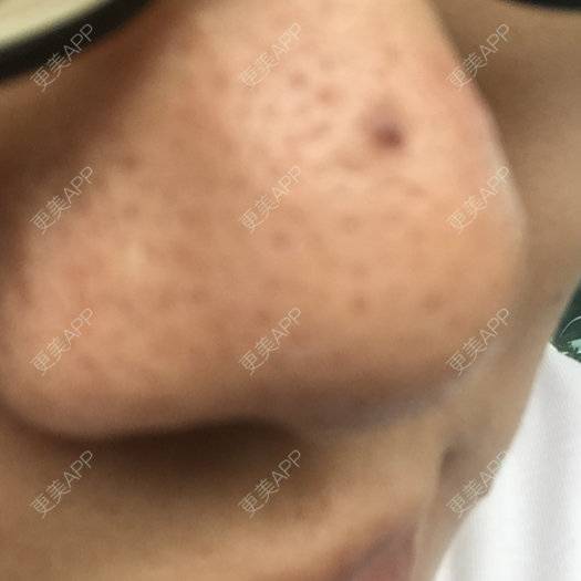 更美 - 更美用户28747179的经验 | 鼻部修复