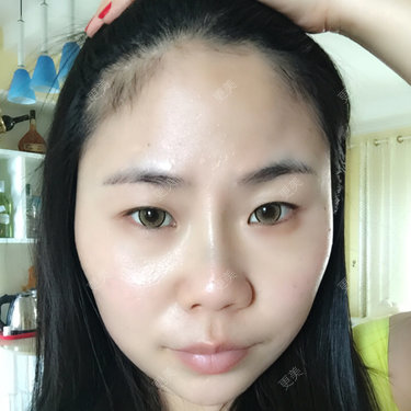 额头中间突出两侧凹陷感觉像寿星的额头真的很羡慕那些额头宽的饱满的