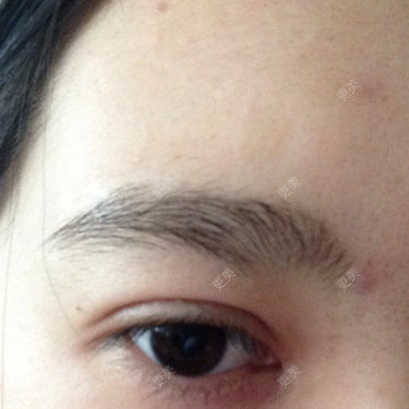 我是做的全切和开内眼角九个月了眼角上面赘肉很明显双眼皮肉条很宽不