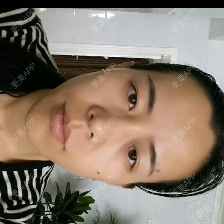 更美 - 水萌儿的自体脂肪垫下巴经验 | 全切双眼皮 | 自体脂肪填充泪沟 | 自体脂肪丰苹果肌 | 自体脂肪垫下巴 | 自体脂肪丰面颊 | 自体脂肪丰太阳穴 | 自体脂肪丰额头 | 自体脂肪垫鼻基底 | 南充