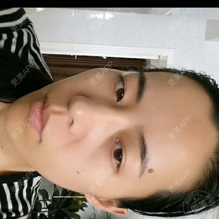 更美 - 水萌儿的自体脂肪垫下巴经验 | 全切双眼皮 | 自体脂肪填充泪沟 | 自体脂肪丰苹果肌 | 自体脂肪垫下巴 | 自体脂肪丰面颊 | 自体脂肪丰太阳穴 | 自体脂肪丰额头 | 自体脂肪垫鼻基底 | 南充