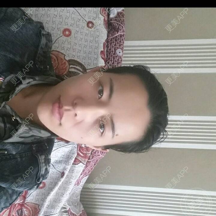 更美 - 水萌儿的自体脂肪垫下巴经验 | 全切双眼皮 | 自体脂肪填充泪沟 | 自体脂肪丰苹果肌 | 自体脂肪垫下巴 | 自体脂肪丰面颊 | 自体脂肪丰太阳穴 | 自体脂肪丰额头 | 自体脂肪垫鼻基底 | 南充