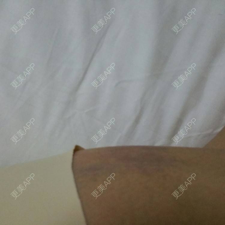 更美 - 水萌儿的自体脂肪垫下巴经验 | 全切双眼皮 | 自体脂肪填充泪沟 | 自体脂肪丰苹果肌 | 自体脂肪垫下巴 | 自体脂肪丰面颊 | 自体脂肪丰太阳穴 | 自体脂肪丰额头 | 自体脂肪垫鼻基底 | 南充