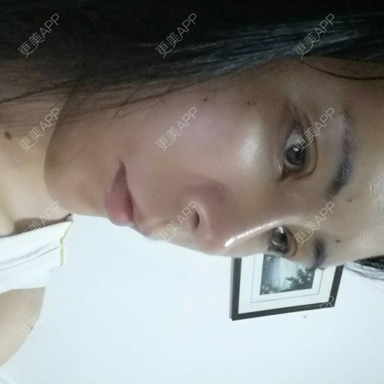 更美 - 水萌儿的自体脂肪垫下巴经验 | 全切双眼皮 | 自体脂肪填充泪沟 | 自体脂肪丰苹果肌 | 自体脂肪垫下巴 | 自体脂肪丰面颊 | 自体脂肪丰太阳穴 | 自体脂肪丰额头 | 自体脂肪垫鼻基底 | 南充