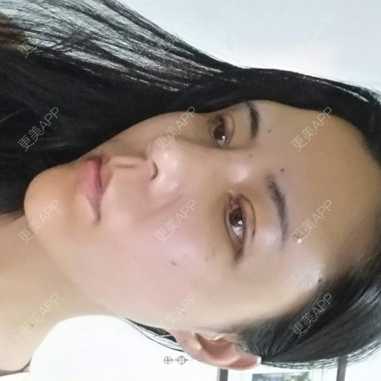 更美 - 水萌儿的自体脂肪垫下巴经验 | 全切双眼皮 | 自体脂肪填充泪沟 | 自体脂肪丰苹果肌 | 自体脂肪垫下巴 | 自体脂肪丰面颊 | 自体脂肪丰太阳穴 | 自体脂肪丰额头 | 自体脂肪垫鼻基底 | 南充