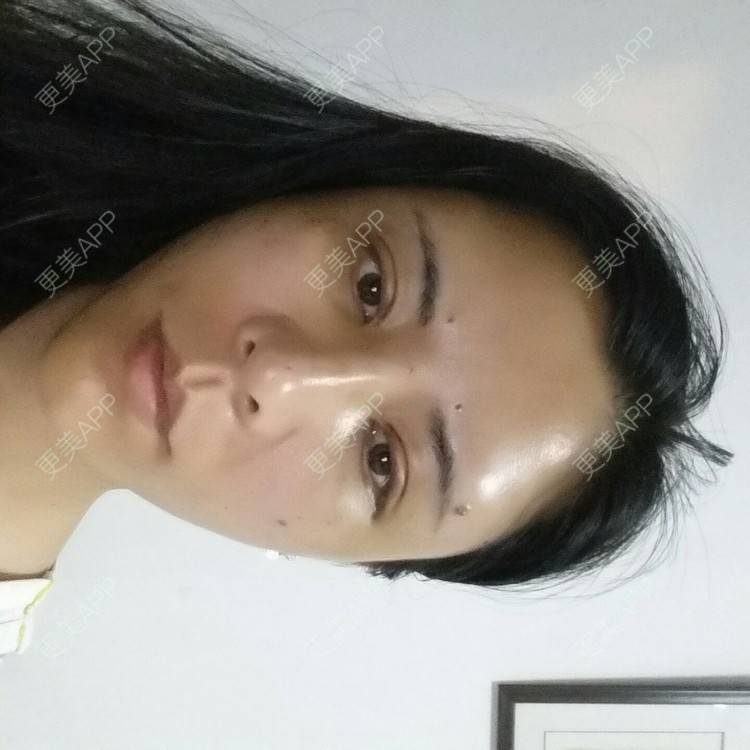 更美 - 水萌儿的自体脂肪垫下巴经验 | 全切双眼皮 | 自体脂肪填充泪沟 | 自体脂肪丰苹果肌 | 自体脂肪垫下巴 | 自体脂肪丰面颊 | 自体脂肪丰太阳穴 | 自体脂肪丰额头 | 自体脂肪垫鼻基底 | 南充