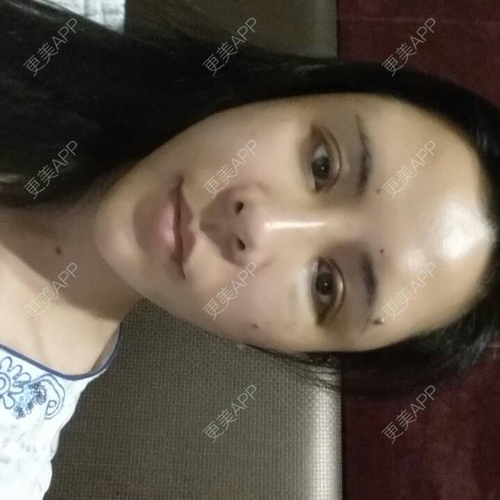 更美 - 水萌儿的自体脂肪垫下巴经验 | 全切双眼皮 | 自体脂肪填充泪沟 | 自体脂肪丰苹果肌 | 自体脂肪垫下巴 | 自体脂肪丰面颊 | 自体脂肪丰太阳穴 | 自体脂肪丰额头 | 自体脂肪垫鼻基底 | 南充