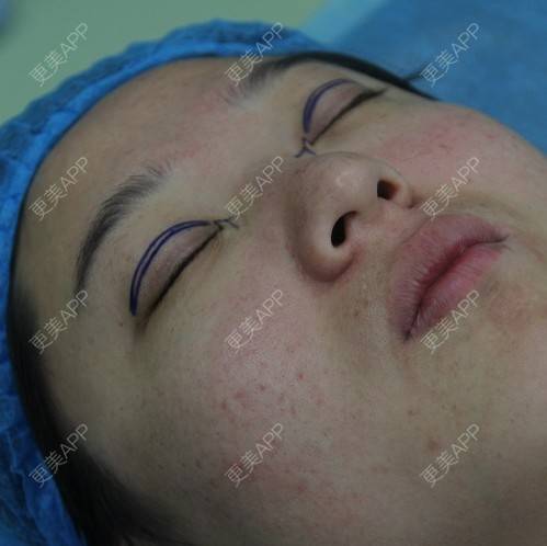 更美 - 切开双眼皮 | 黑脸娃娃 | 深圳