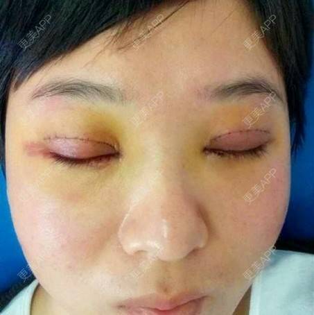 更美 - 切开双眼皮 | 黑脸娃娃 | 深圳