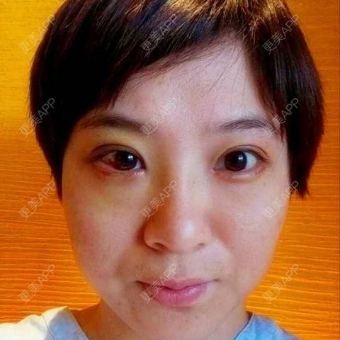 更美 - 切开双眼皮 | 黑脸娃娃 | 深圳