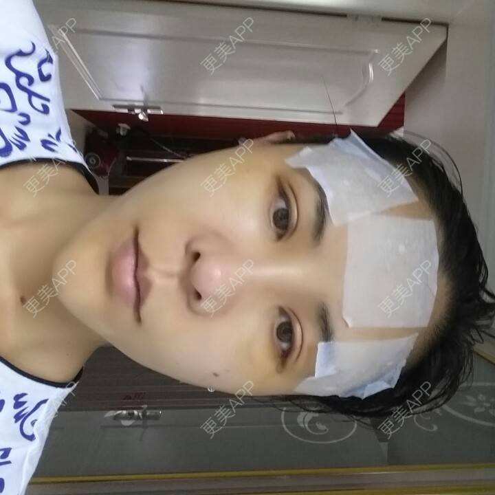 更美 - 水萌儿的自体脂肪垫下巴经验 | 自体脂肪填充泪沟 | 自体脂肪垫鼻基底 | 自体脂肪丰面颊 | 自体脂肪丰太阳穴 | 自体脂肪丰额头 | 全切双眼皮 | 自体脂肪丰苹果肌 | 自体脂肪垫下巴 | 南充