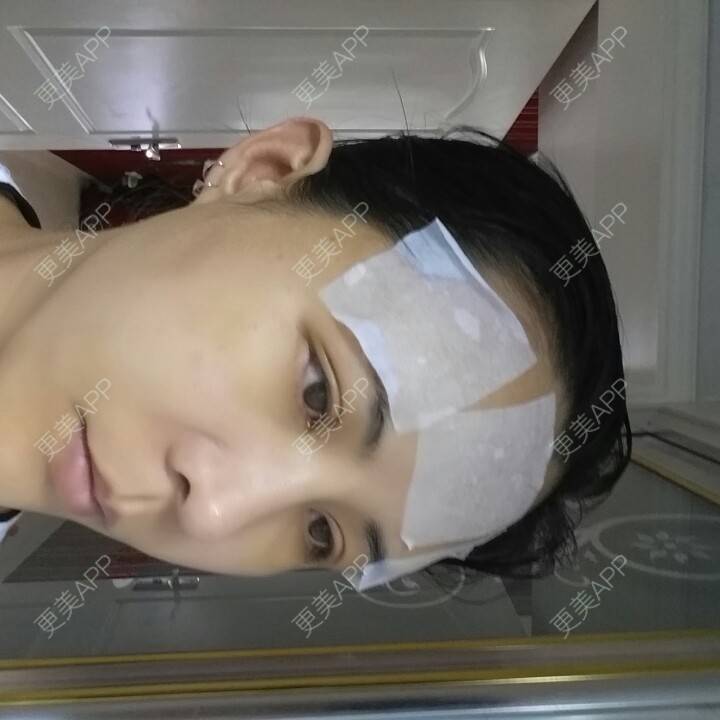 更美 - 水萌儿的自体脂肪垫下巴经验 | 自体脂肪填充泪沟 | 自体脂肪垫鼻基底 | 自体脂肪丰面颊 | 自体脂肪丰太阳穴 | 自体脂肪丰额头 | 全切双眼皮 | 自体脂肪丰苹果肌 | 自体脂肪垫下巴 | 南充