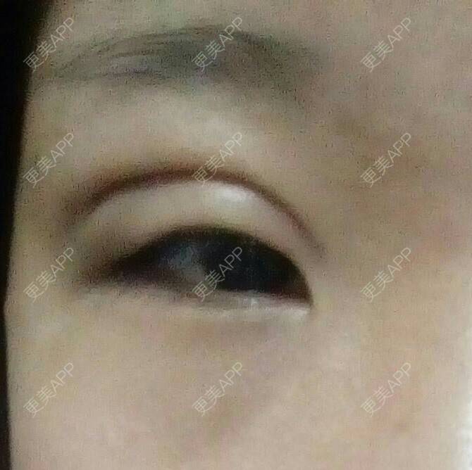 更美 - 你给的恶作剧的经验 | 上眼睑去脂 | 天津