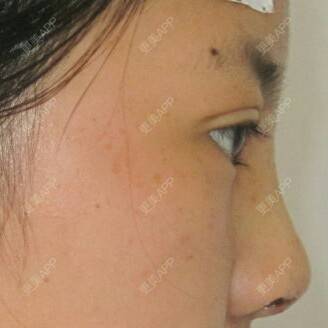 更美 - 三小红花的全切双眼皮经验 | 硅胶隆鼻 | 自体软骨垫鼻尖 | 全切双眼皮 | 定点双眼皮 | 昆明