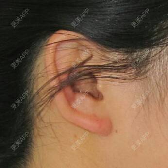 更美 - 三小红花的全切双眼皮经验 | 硅胶隆鼻 | 自体软骨垫鼻尖 | 全切双眼皮 | 定点双眼皮 | 昆明