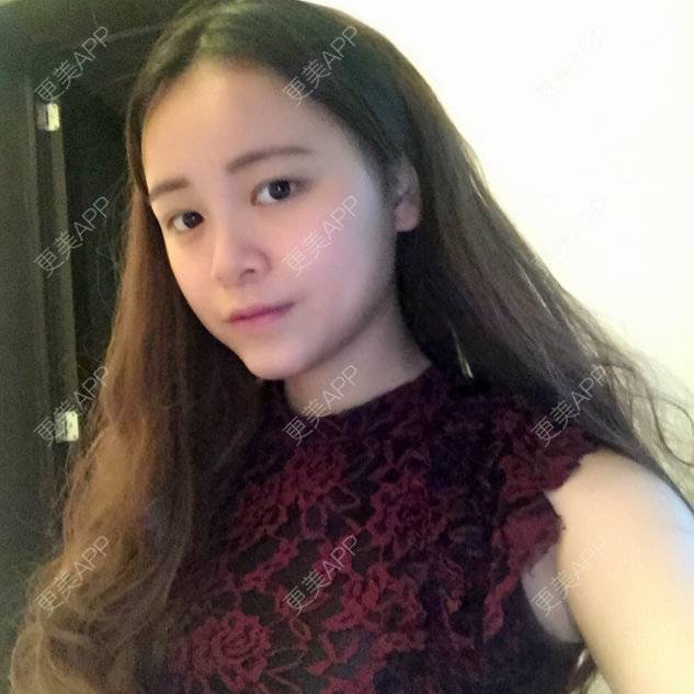 更美 - 我愛何文廣的经验 | 开眼角