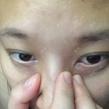 为什么我开眼角都恢复一两年的时间了内眼角还留有白色的疤痕
