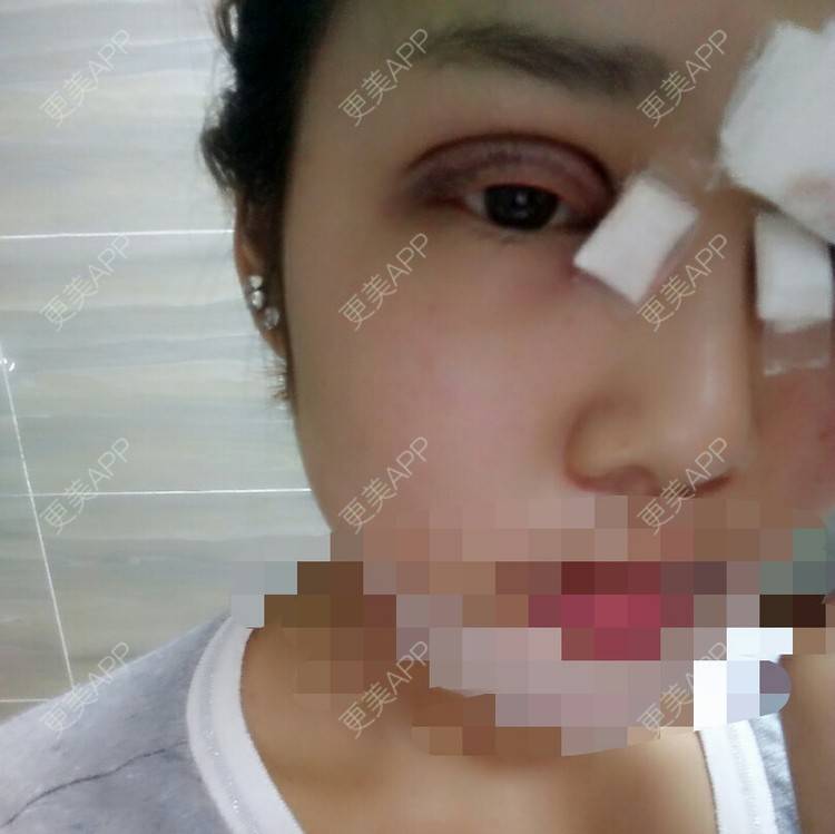 更美 - 切开双眼皮+开内眼角+硅胶垫下巴+瘦脸针 | 激光洗纹身 | 产后塑形 | 下颌角 | 黑脸娃娃 | 赣州