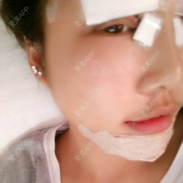 更美 - 切开双眼皮+开内眼角+硅胶垫下巴+瘦脸针 | 激光洗纹身 | 产后塑形 | 下颌角 | 黑脸娃娃 | 赣州