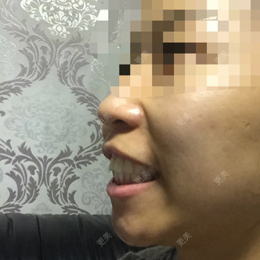 想请教一下 今年32岁 我这个突出的程度是