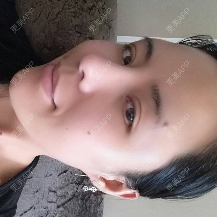 更美 - 水萌儿的自体脂肪垫下巴经验 | 自体脂肪填充泪沟 | 自体脂肪垫鼻基底 | 自体脂肪丰面颊 | 自体脂肪丰太阳穴 | 自体脂肪丰额头 | 全切双眼皮 | 自体脂肪丰苹果肌 | 自体脂肪垫下巴 | 南充