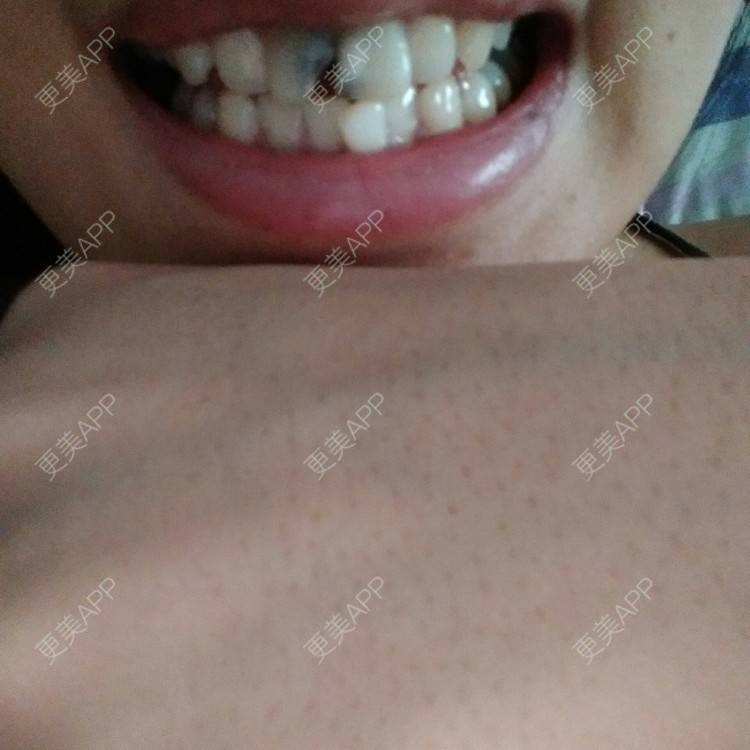 更美 - 更美用户92493049的经验 | 牙齿