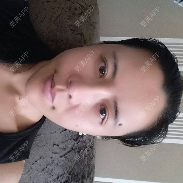 更美 - 水萌儿的自体脂肪垫下巴经验 | 自体脂肪填充泪沟 | 自体脂肪垫鼻基底 | 自体脂肪丰面颊 | 自体脂肪丰太阳穴 | 自体脂肪丰额头 | 全切双眼皮 | 自体脂肪丰苹果肌 | 自体脂肪垫下巴 | 南充