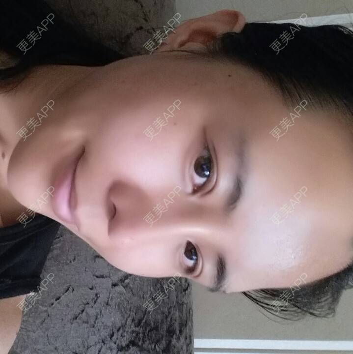 更美 - 水萌儿的自体脂肪垫下巴经验 | 自体脂肪填充泪沟 | 自体脂肪垫鼻基底 | 自体脂肪丰面颊 | 自体脂肪丰太阳穴 | 自体脂肪丰额头 | 全切双眼皮 | 自体脂肪丰苹果肌 | 自体脂肪垫下巴 | 南充