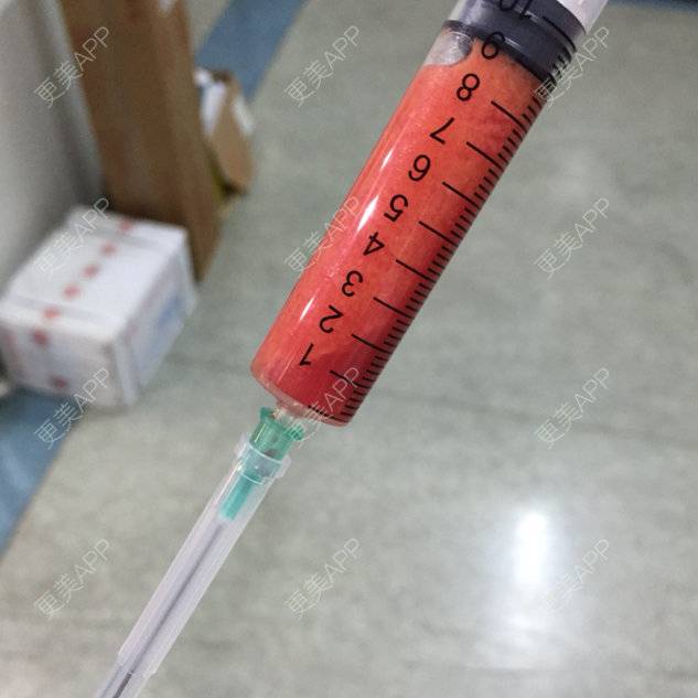 更美 - shj888的吸脂瘦脸经验 | 吸脂瘦脸 | 美购日记 | 广州