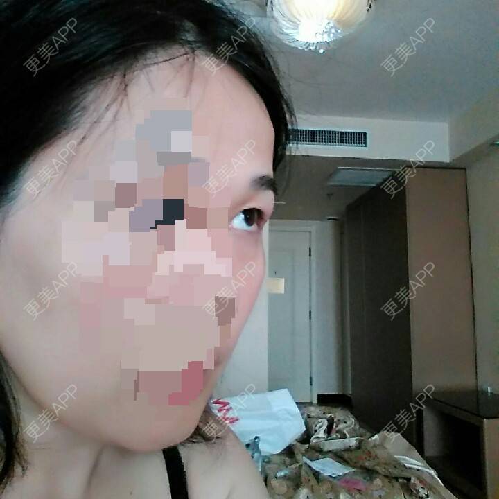 更美 - 13*******13的经验 | 面部轮廓 | 眼部整形