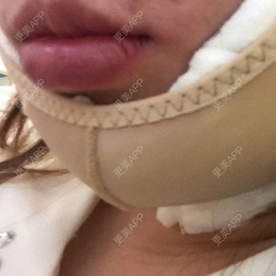 更美 - shj888的吸脂瘦脸经验 | 吸脂瘦脸 | 美购日记 | 广州