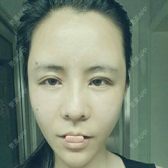 更美 - 水萌儿的自体脂肪垫下巴经验 | 自体脂肪填充泪沟 | 自体脂肪垫鼻基底 | 自体脂肪丰面颊 | 自体脂肪丰太阳穴 | 自体脂肪丰额头 | 全切双眼皮 | 自体脂肪丰苹果肌 | 自体脂肪垫下巴 | 南充