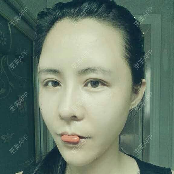 更美 - 水萌儿的自体脂肪垫下巴经验 | 自体脂肪填充泪沟 | 自体脂肪垫鼻基底 | 自体脂肪丰面颊 | 自体脂肪丰太阳穴 | 自体脂肪丰额头 | 全切双眼皮 | 自体脂肪丰苹果肌 | 自体脂肪垫下巴 | 南充