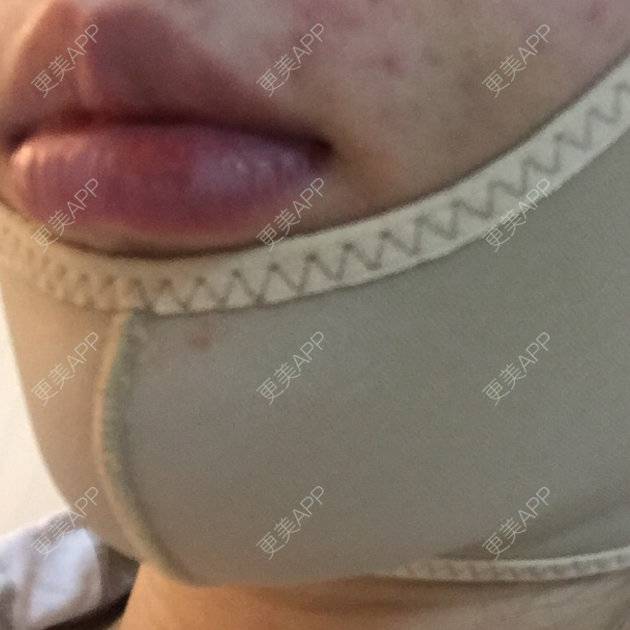 更美 - shj888的吸脂瘦脸经验 | 吸脂瘦脸 | 美购日记 | 广州