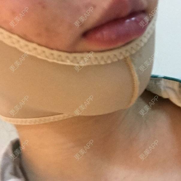 更美 - shj888的吸脂瘦脸经验 | 吸脂瘦脸 | 美购日记 | 广州