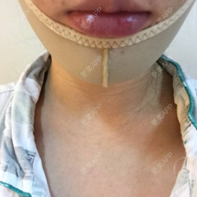 更美 - shj888的吸脂瘦脸经验 | 吸脂瘦脸 | 美购日记 | 广州