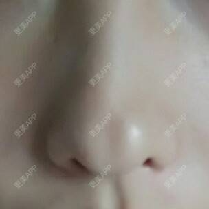 更美 - 潘潘一的经验 | 隆鼻