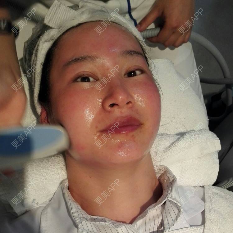 更美 - 更美用户27416885的激光淡化红血丝经验 | 果酸焕肤 | 红蓝光清痘 | 激光淡化红血丝 | 上海