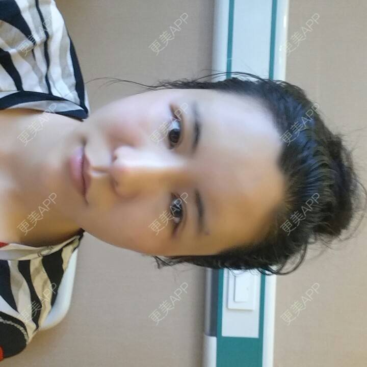 更美 - 水萌儿的自体脂肪垫下巴经验 | 自体脂肪填充泪沟 | 自体脂肪垫鼻基底 | 自体脂肪丰面颊 | 自体脂肪丰太阳穴 | 自体脂肪丰额头 | 全切双眼皮 | 自体脂肪丰苹果肌 | 自体脂肪垫下巴 | 南充