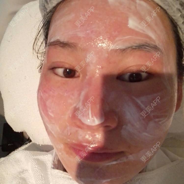 更美 - 更美用户27416885的激光淡化红血丝经验 | 果酸焕肤 | 红蓝光清痘 | 激光淡化红血丝 | 上海