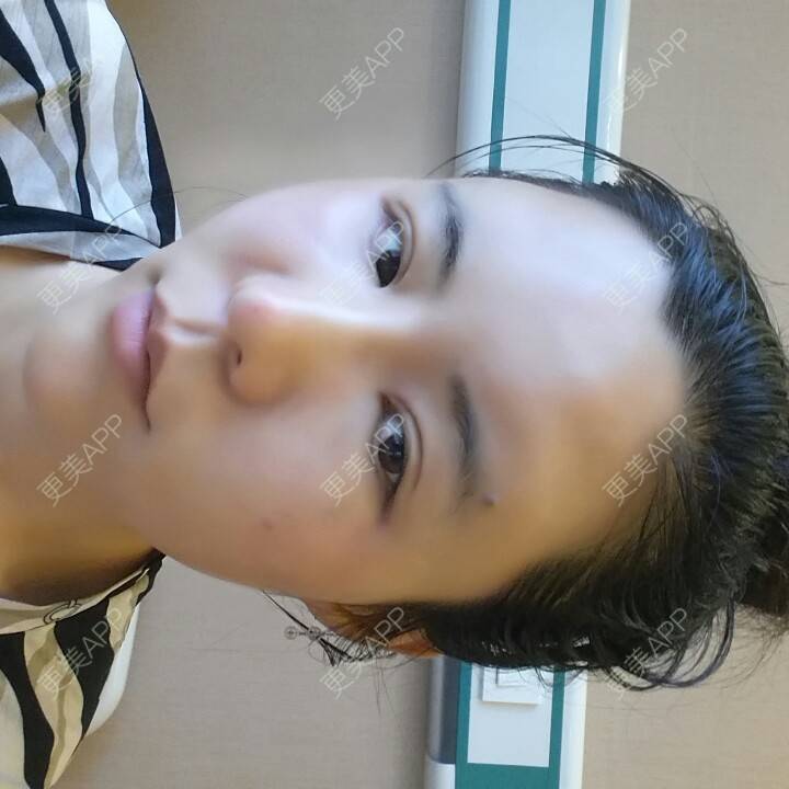 更美 - 水萌儿的自体脂肪垫下巴经验 | 自体脂肪填充泪沟 | 自体脂肪垫鼻基底 | 自体脂肪丰面颊 | 自体脂肪丰太阳穴 | 自体脂肪丰额头 | 全切双眼皮 | 自体脂肪丰苹果肌 | 自体脂肪垫下巴 | 南充