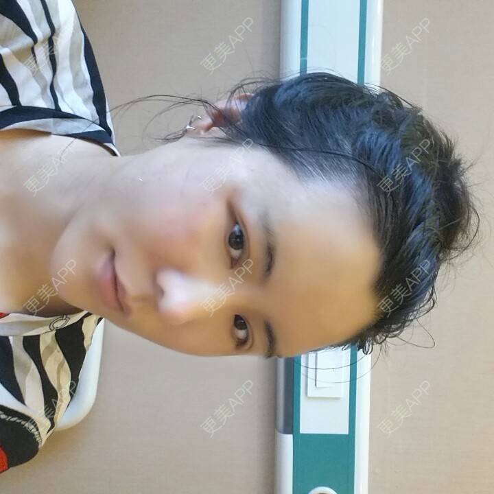 更美 - 水萌儿的自体脂肪垫下巴经验 | 自体脂肪填充泪沟 | 自体脂肪垫鼻基底 | 自体脂肪丰面颊 | 自体脂肪丰太阳穴 | 自体脂肪丰额头 | 全切双眼皮 | 自体脂肪丰苹果肌 | 自体脂肪垫下巴 | 南充