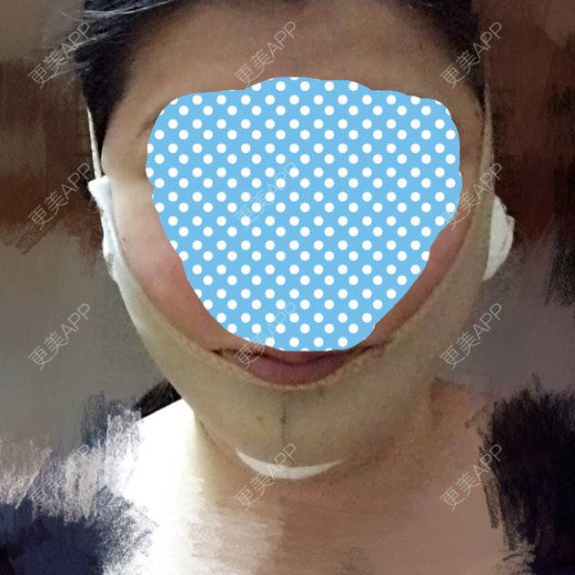 更美 - 更美用户91786455的除皱瘦脸经验 | 脸部抽脂 | 除皱瘦脸 | 杭州