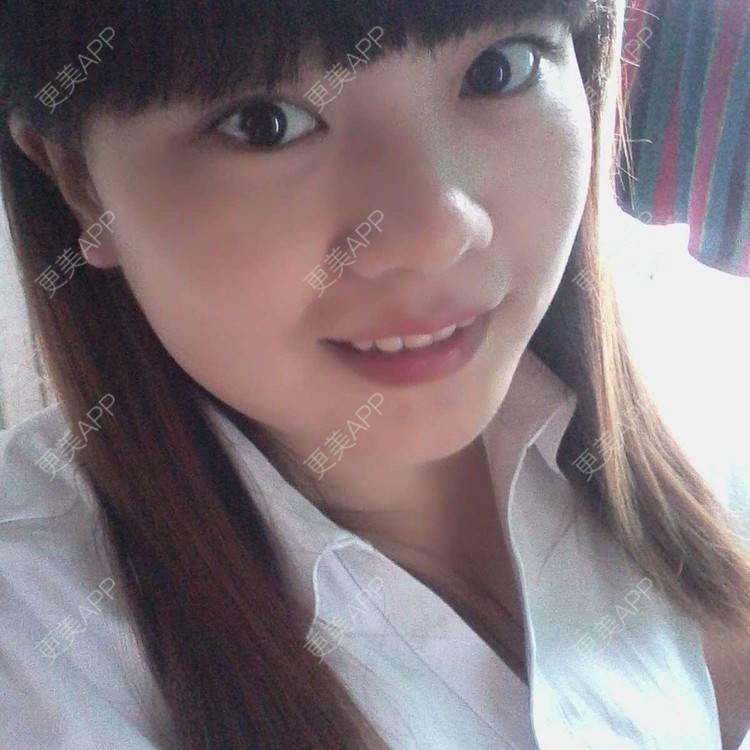 更美 - ┍談談凊o-的经验 | 自体脂肪淡化黑眼圈