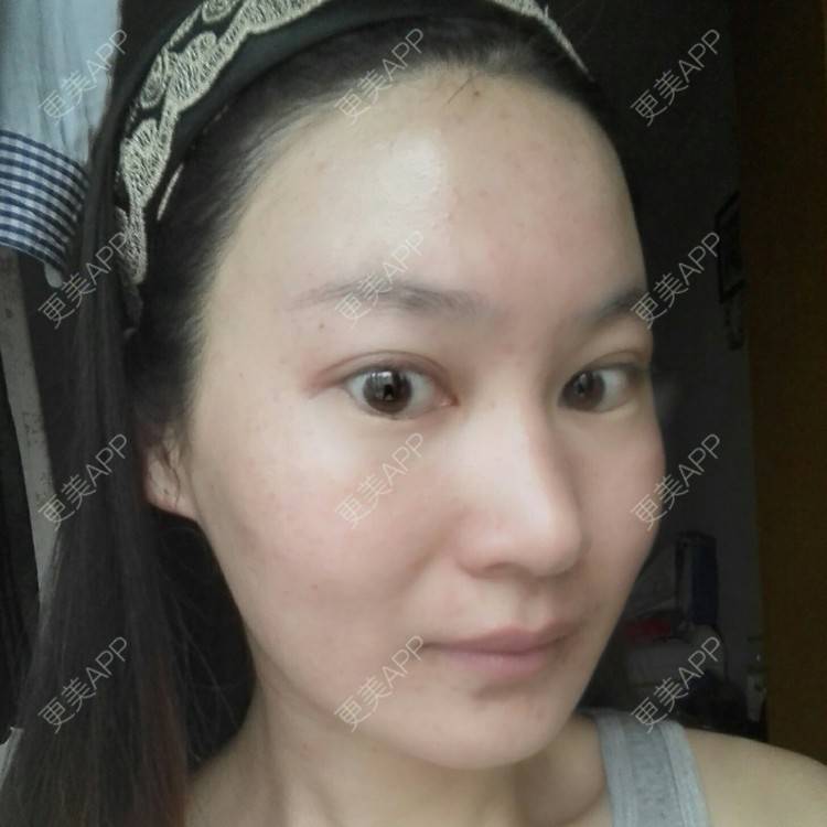 更美 - 更美用户27416885的激光淡化红血丝经验 | 果酸焕肤 | 红蓝光清痘 | 激光淡化红血丝 | 上海