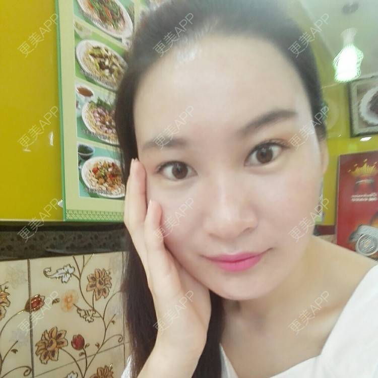 更美 - 更美用户27416885的激光淡化红血丝经验 | 果酸焕肤 | 红蓝光清痘 | 激光淡化红血丝 | 上海