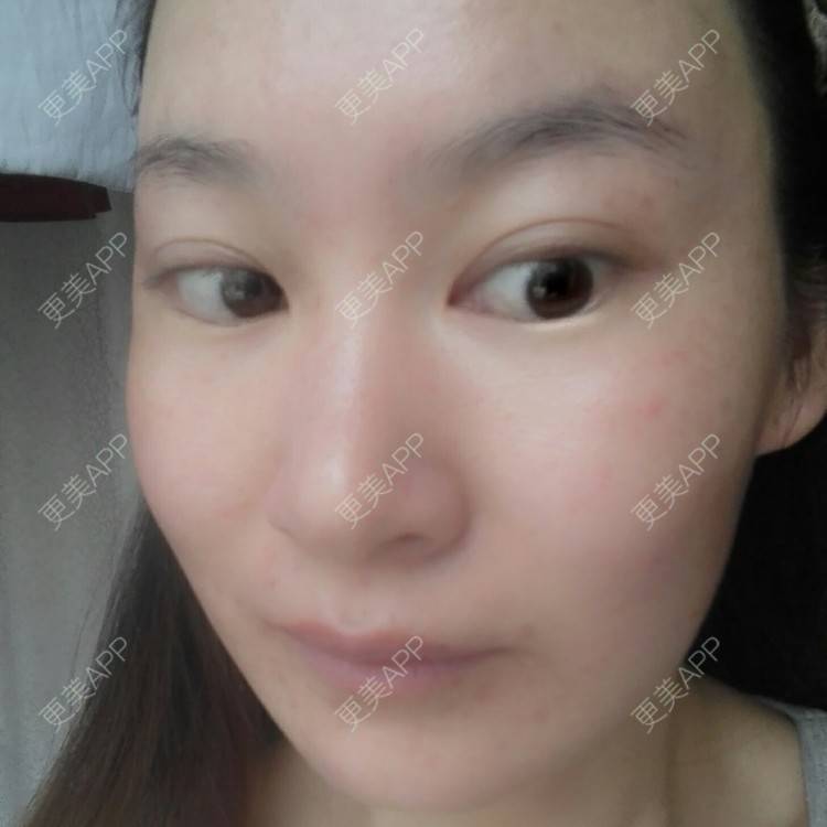 更美 - 更美用户27416885的激光淡化红血丝经验 | 果酸焕肤 | 红蓝光清痘 | 激光淡化红血丝 | 上海
