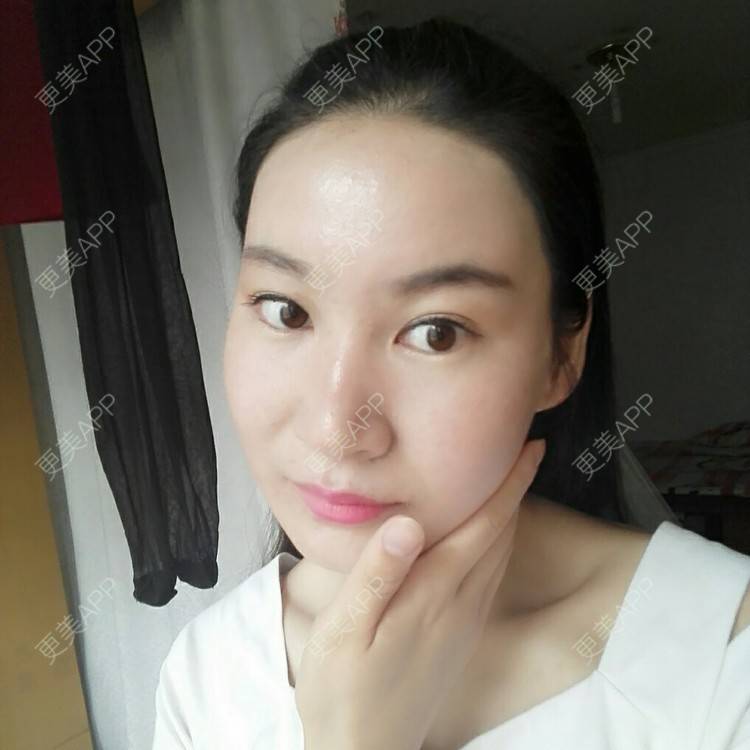 更美 - 更美用户27416885的激光淡化红血丝经验 | 果酸焕肤 | 红蓝光清痘 | 激光淡化红血丝 | 上海
