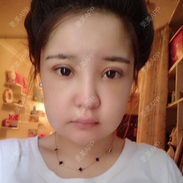 更美 - xirennnnn的定点双眼皮经验 | 双下巴溶脂 | 光纤溶脂瘦脸. | 光纤溶脂下巴 | 定点双眼皮 | 激光溶脂瘦脸 | 开外眼角 | 南昌