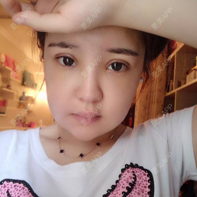 更美 - xirennnnn的定点双眼皮经验 | 双下巴溶脂 | 光纤溶脂瘦脸. | 光纤溶脂下巴 | 定点双眼皮 | 激光溶脂瘦脸 | 开外眼角 | 南昌